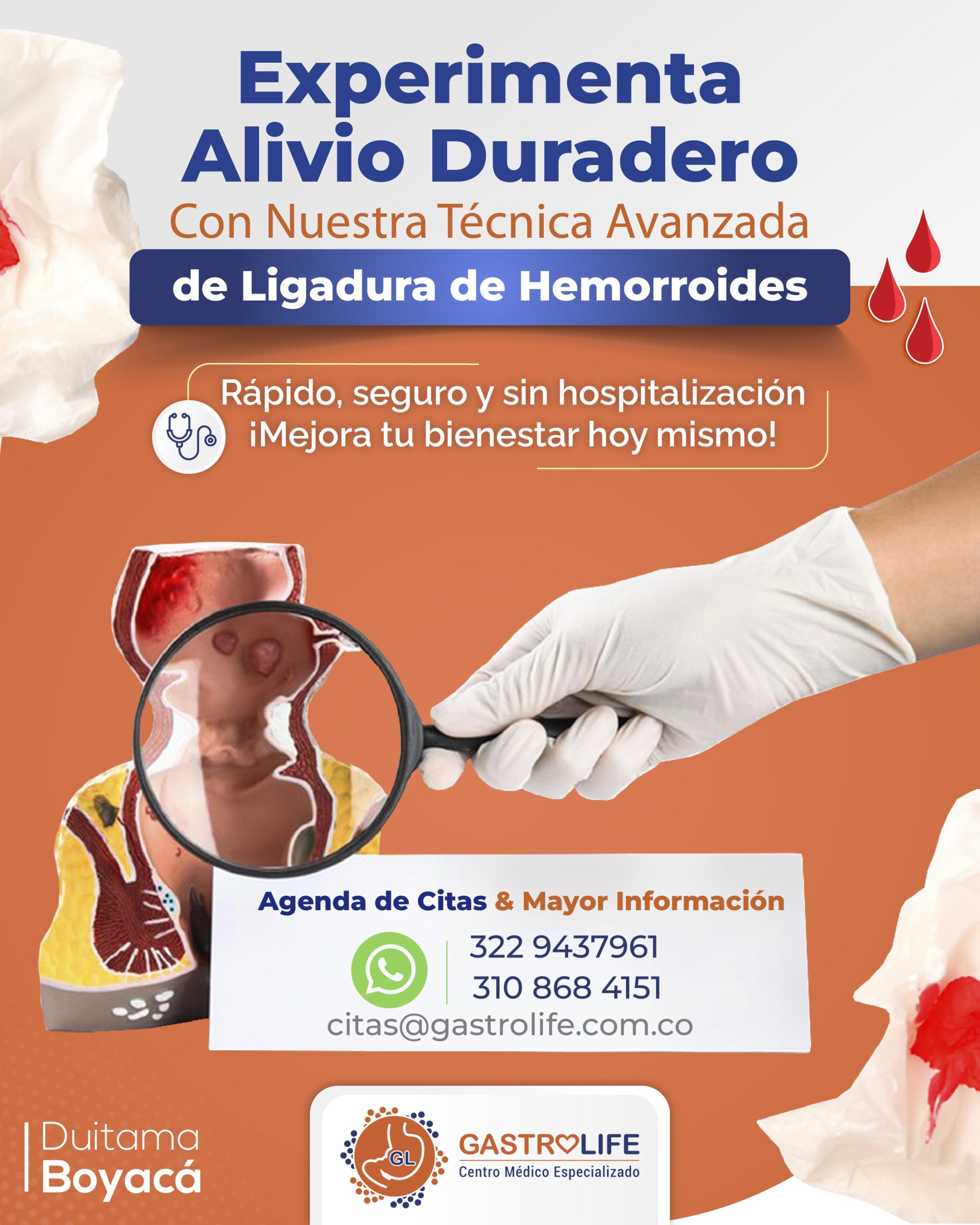 LIGADURA HEMORROIDES LIGADURA HEMORROIDES